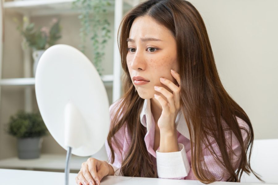 Mulher com melasma no rosto olhando no espelho